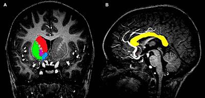 Larger Subcortical Gray Matter Structures and Smaller Corpora Callosa at Age 5 Years in HIV Infected Children on Early ART